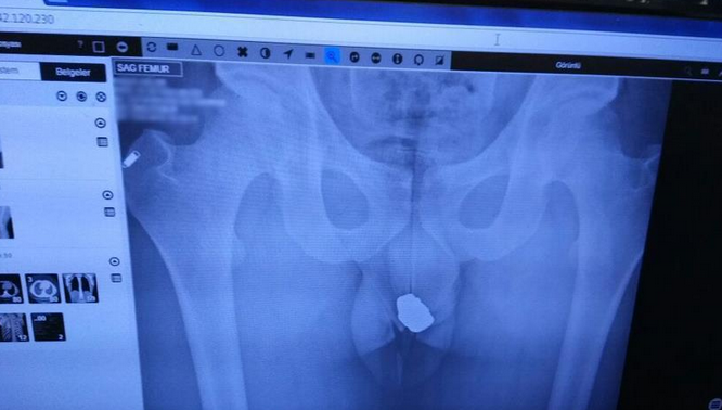 dief juwelen kont, dief opmerkelijk achterste